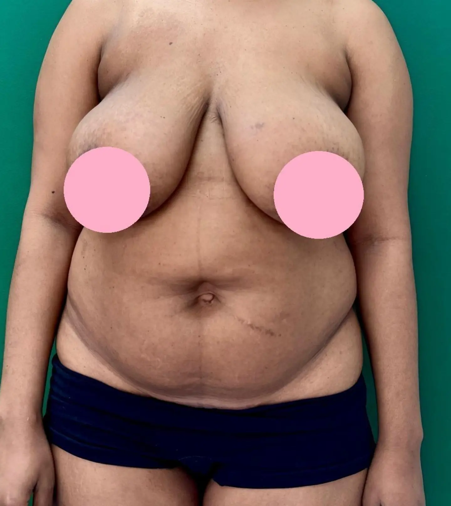 Breast Reduction Before